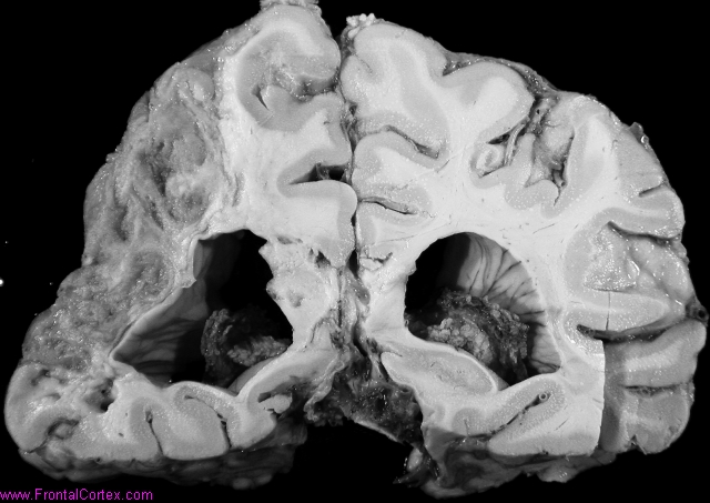Organizing infarct, left posteri